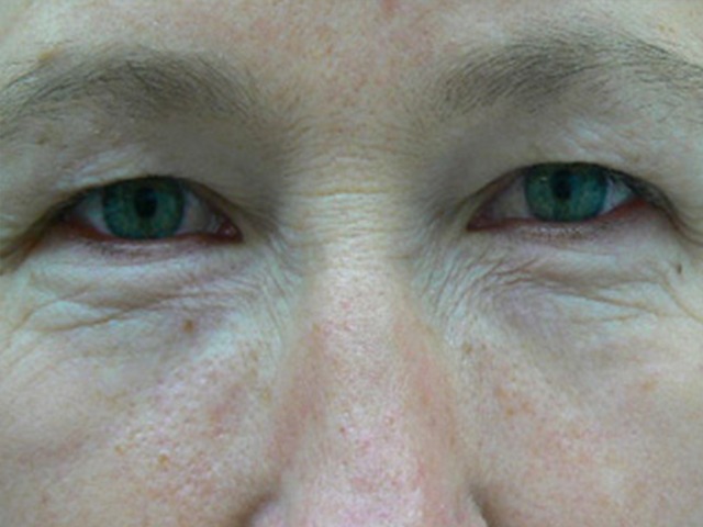Eyelid Surgery Before and After