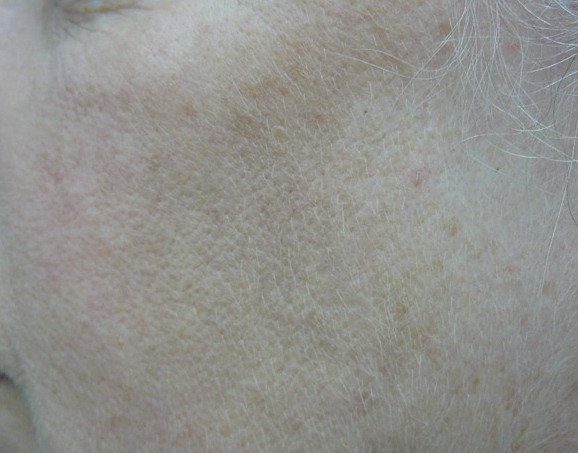 IPL Hair Removal Before and After