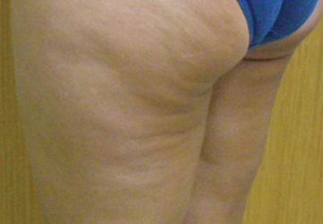 Cellulite-before