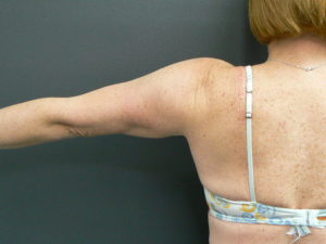 tumescent-liposuction-treatment-after