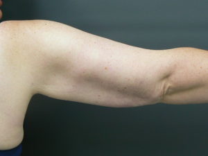 Tumescent Liposuction treatment arms -after