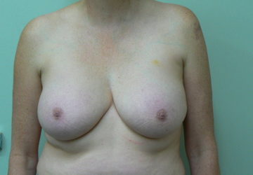 breast-reduction-female-after