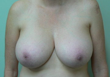 breast-reduction-female-before