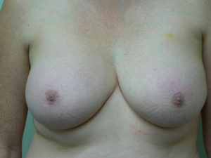 breast-reduction-female-after