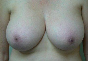 breast-reduction-female-before