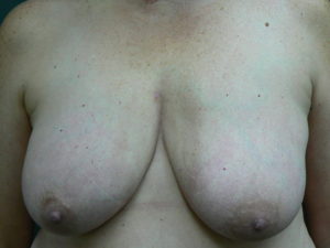 breast-reduction-female-after