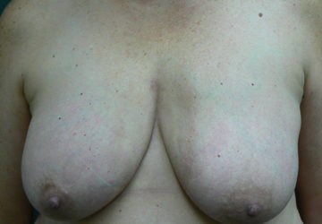 breast-reduction-female-after