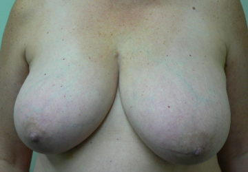 breast-reduction-female-before