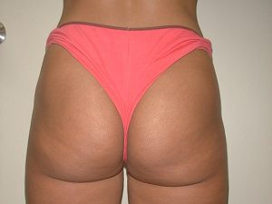 Tumescent Liposuction After