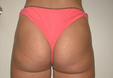 Tumescent Liposuction treatment -after