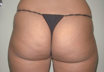 tumescent-liposuction-treatment-before