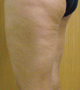 Cellulite-after