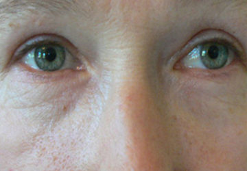 eyelid-surgery-after