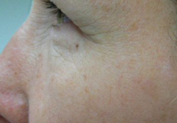 eyelid-surgery-before