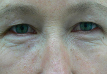 eyelid-surgery-before