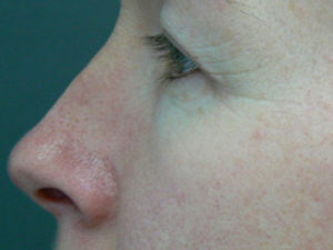 eyelid-surgery-before