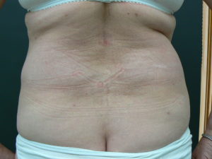 hips-fat-transfer-after