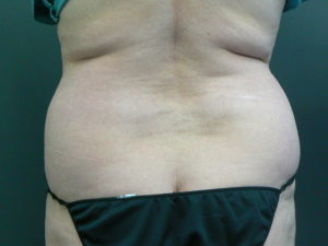 hips-fat-transfer-before