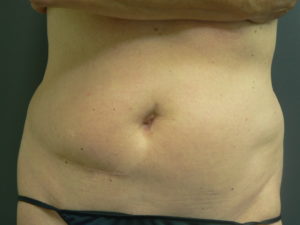 tumescent-liposuction-treatment-before