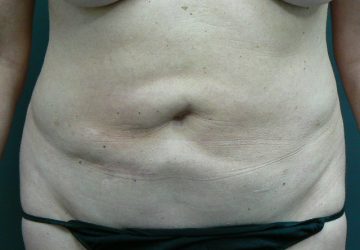 Tumescent Liposuction treatment -after