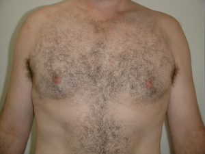 male-breast-reduction-after