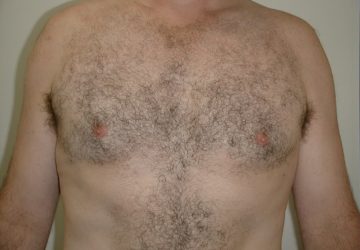 male-breast-reduction-after