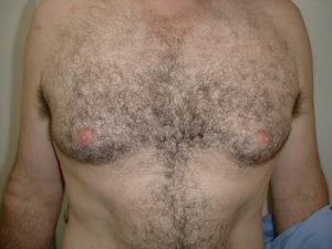 male-breast-reduction-before