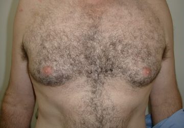 male-breast-reduction-before