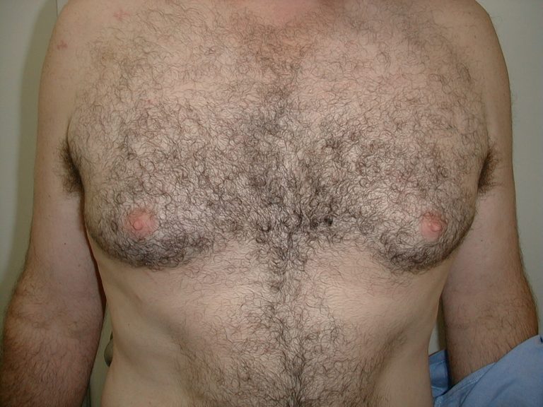 Male Breast Reduction Encorė Cosmetic Clinic