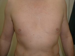 male-breast-reduction-after