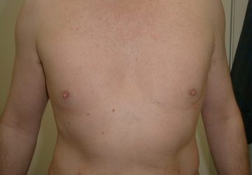 male-breast-reduction-after