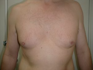 male-breast-reduction-before