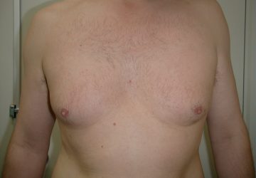 male-breast-reduction-before