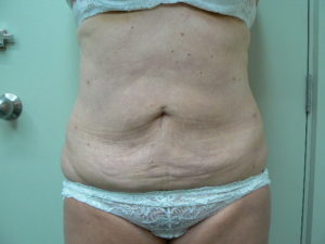 Tumescent Liposuction treatment -after