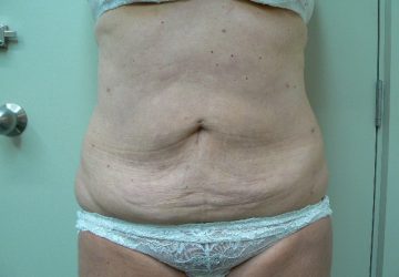 Tumescent Liposuction treatment -after