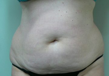 tumescent-liposuction-treatment-before