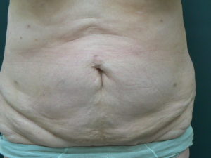 Tumescent Liposuction treatment-after