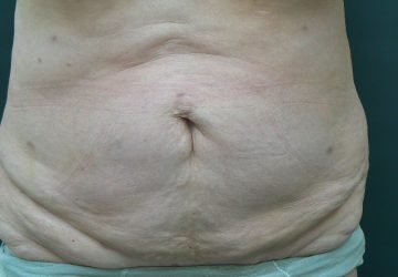 Tumescent Liposuction treatment-after