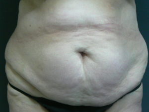 tumescent-liposuction-treatment-before