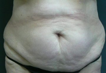 tumescent-liposuction-treatment-before