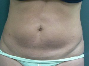 Tumescent Liposuction After