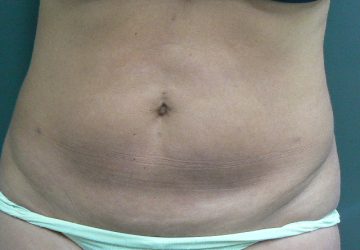 Tumescent Liposuction treatment -after