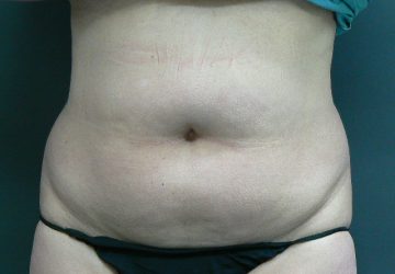 tumescent-liposuction-treatment-before