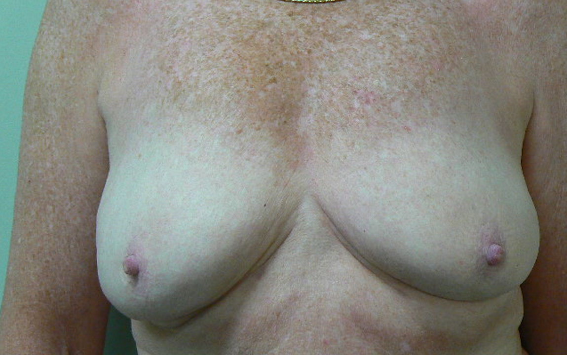 Breast reduction. Encorė Cosmetic Clinic