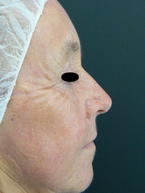 Laser facial rejuvenation. Encorė Cosmetic Clinic
