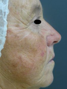 Laser Facial rejuvenation. Encorė Cosmetic Clinic
