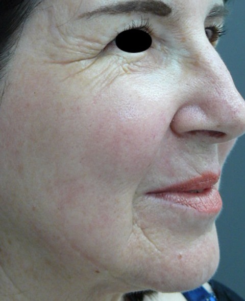 Laser facial rejuvenation. Encorė Cosmetic Clinic