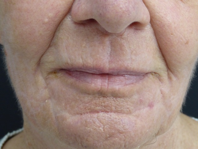 Laser facial resurfacing. Encorė Cosmetic Clinic