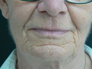Laser facial resurfacing  Encorė Cosmetic Clinic