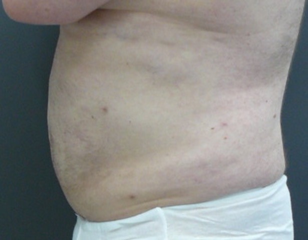 Tumescent Liposuction. Encorė Cosmetic Clinic